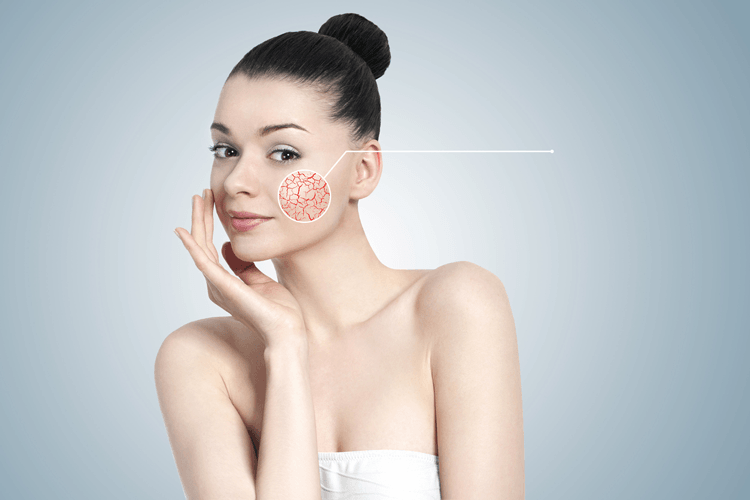 750x500-Coupersose-Behandlung-Ludmilla-Giebels-Cosmetics-Osnabrueck-iStock-178895501-WEB